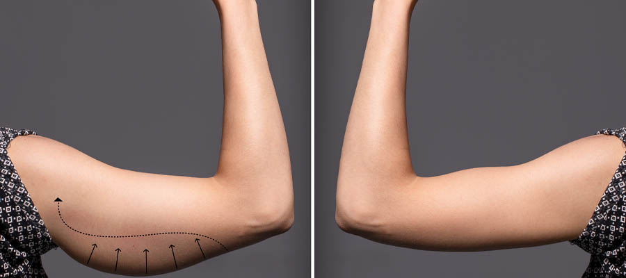 תמונות לפני ואחרי - ניתוח מתיחת זרועות
